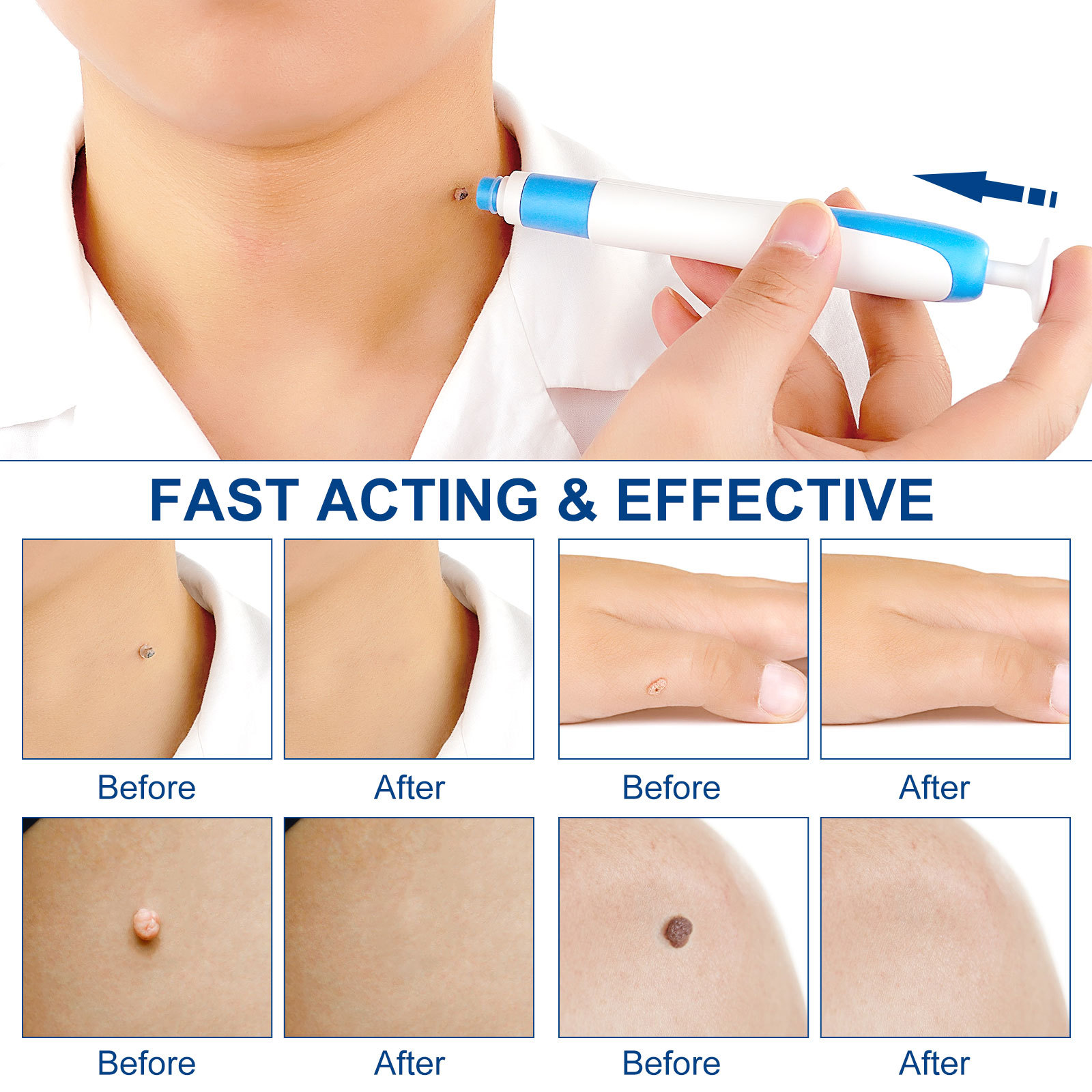 2-IN-1 Auto Skin Tag Removal K - Home Improvement And Tools บทวิจารณ์และราคา