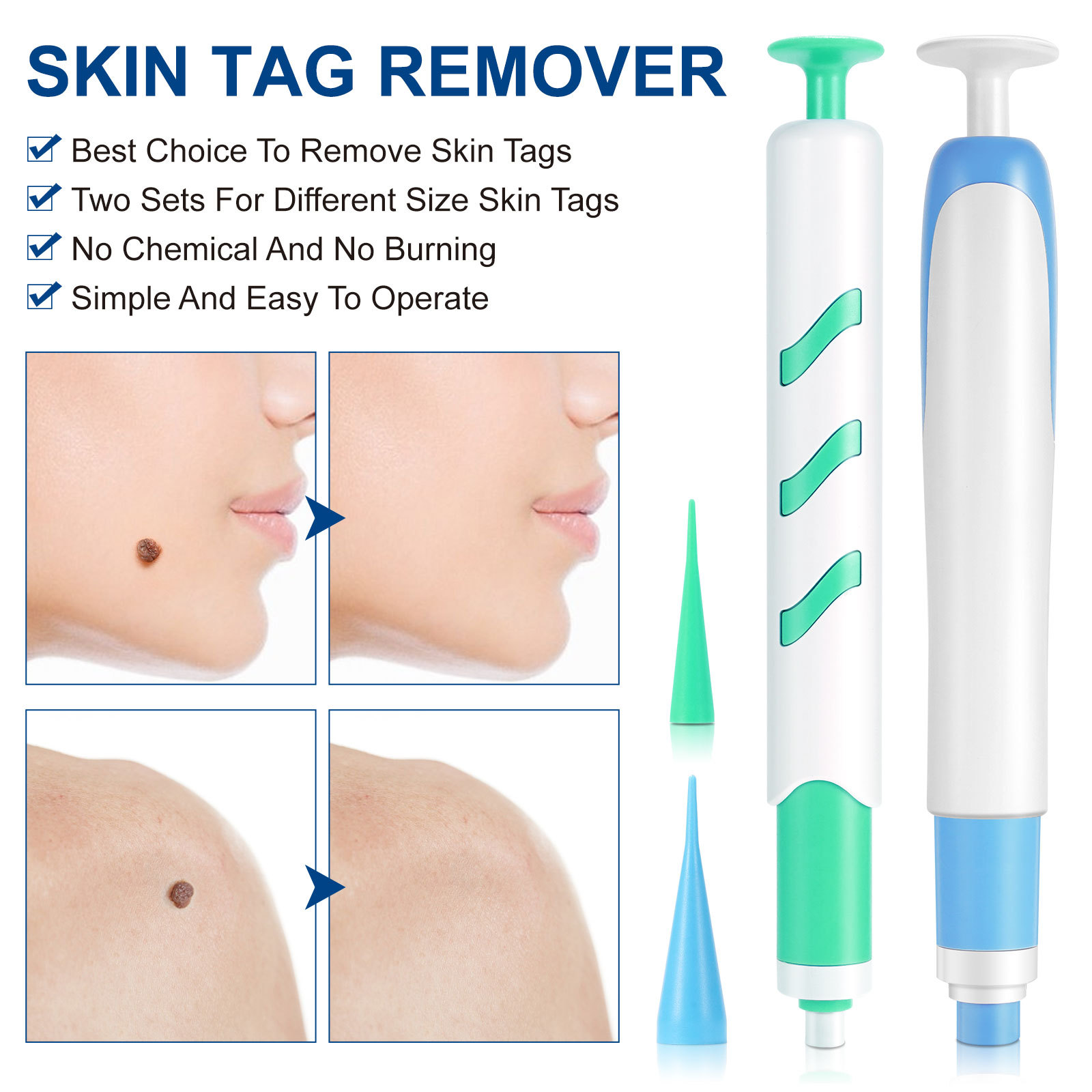 2-IN-1 Auto Skin Tag Removal K - Home Improvement And Tools บทวิจารณ์และราคา